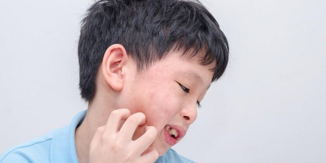 Jenis Alergi yang Sering Menimpa Anak-anak